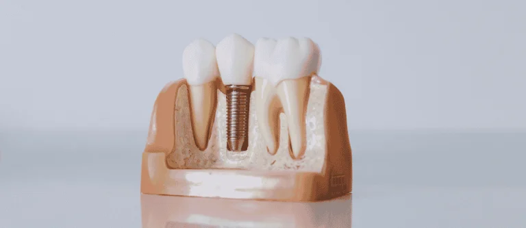 dental implants after years of missing teeth