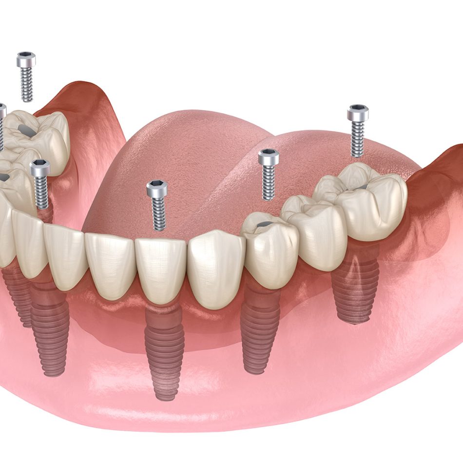 Mandibular prosthesis All on 4 system supported by implants, screw fixation. Medically accurate 3D illustration of dental concept